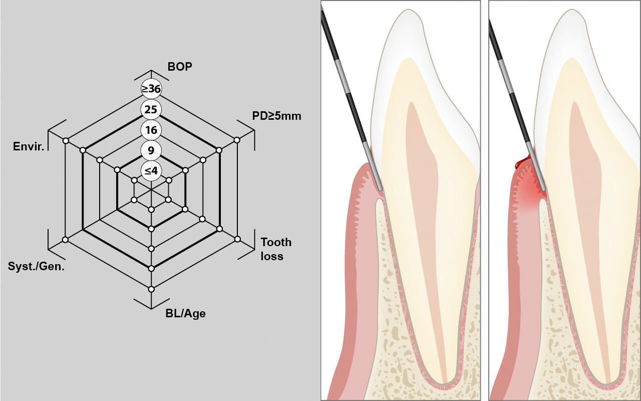 Bluten auf Sondierung (BOP)